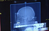 Video: Treatment of brain tumors with the Gamma Knife