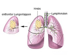 Schema Lungenlappenentfernung