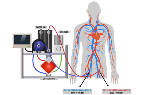 Illustration ECMO