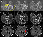 Brain imaging in epileptology