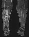 Vascular anomaly in the leg