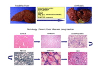 Liver cirrhoses