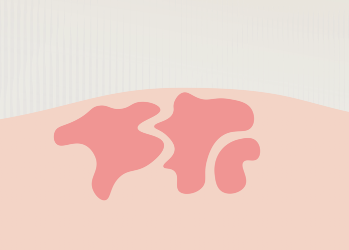 Ilustration 1: Behandlung einer venösen Malformation