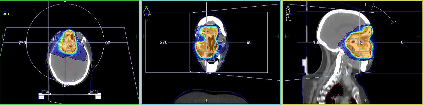 Exemplarische Dosisverteilung einer Nasennebenhöhlen-Bestrahlung