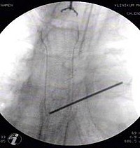 Implantation eines Metallgitterstents zur Palliation einer malignen Trachealstenose