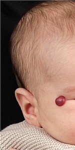 Babykopf mit Anomalie am Auge