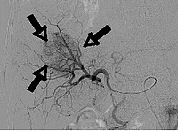 Angiogramm mit stark durchblutetem Tumor (Pfeile)