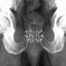 Röntgenbild nach Implantation der Jod Seeds