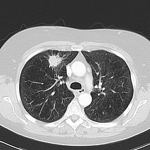 Computertomographie Lungenkrebs