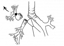 Schema Manschettenresektion