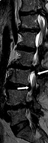 Spinalkanalstenose