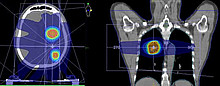 Beispiele für Dosisverteilung mit Zielvolumina in Kopf und Lunge