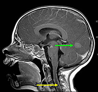 Neuroblastom