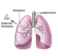 Schema Metastasenentfernung