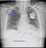 Ein-Kammer-ICD