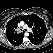 Computertomographie zentraler Lungenkrebs