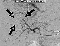 Angiogramm nach TACE mit verödetem Tumor 