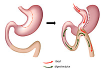 Omega Loop Bypass bei Adipositas