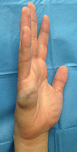 Hand mit Gefäßanomalie