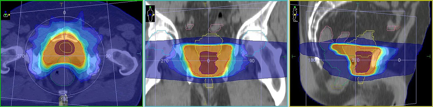 Exemplarische Dosisverteilung einer Prostata-Bestrahlung