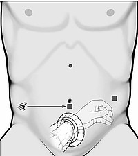 Schlüssellochtechnik Endohand