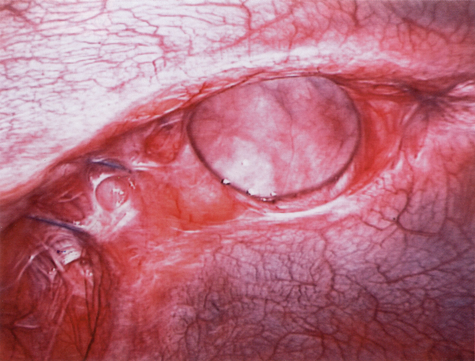 Operation bei Hernien (Bruchoperationen) UMM Universitätsmedizin Mannheim