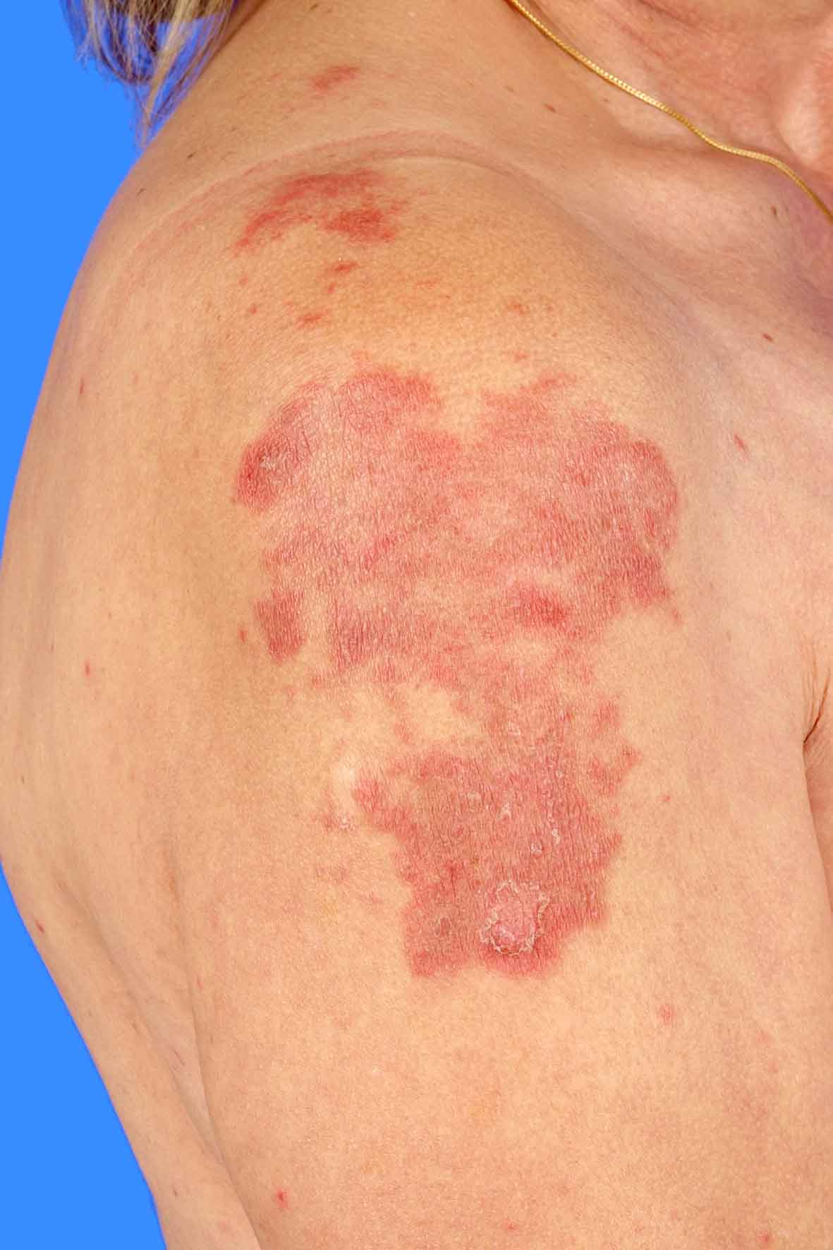 Lupus erythematodes