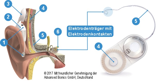 Cochlea Implant Umm Universitätsmedizin Mannheim
