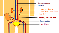 Schema einer Nierentransplantation