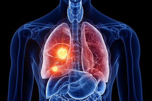 Das Bild zeigt eine medizinische Illustration der Organe des Thorax, bei der die Lunge hervorgehoben ist, die sichtbar einen Tumor aufweist.
