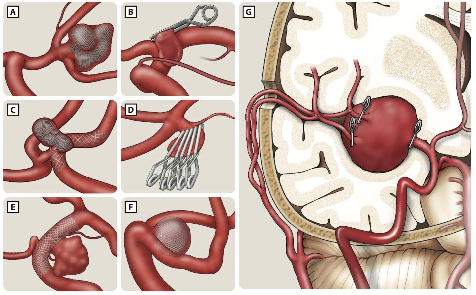 Behandlungsverfahren bei Aneurysmen, genauere Beschreibung am Textende